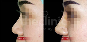 Rhinoplasty